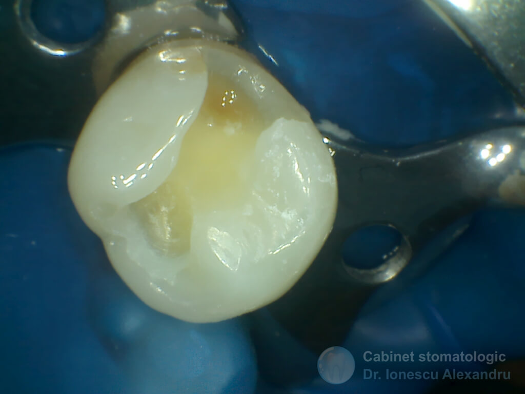 Obturaţie Compozit cu Casetă Distală la un Premolar Inferior - Imagine 2