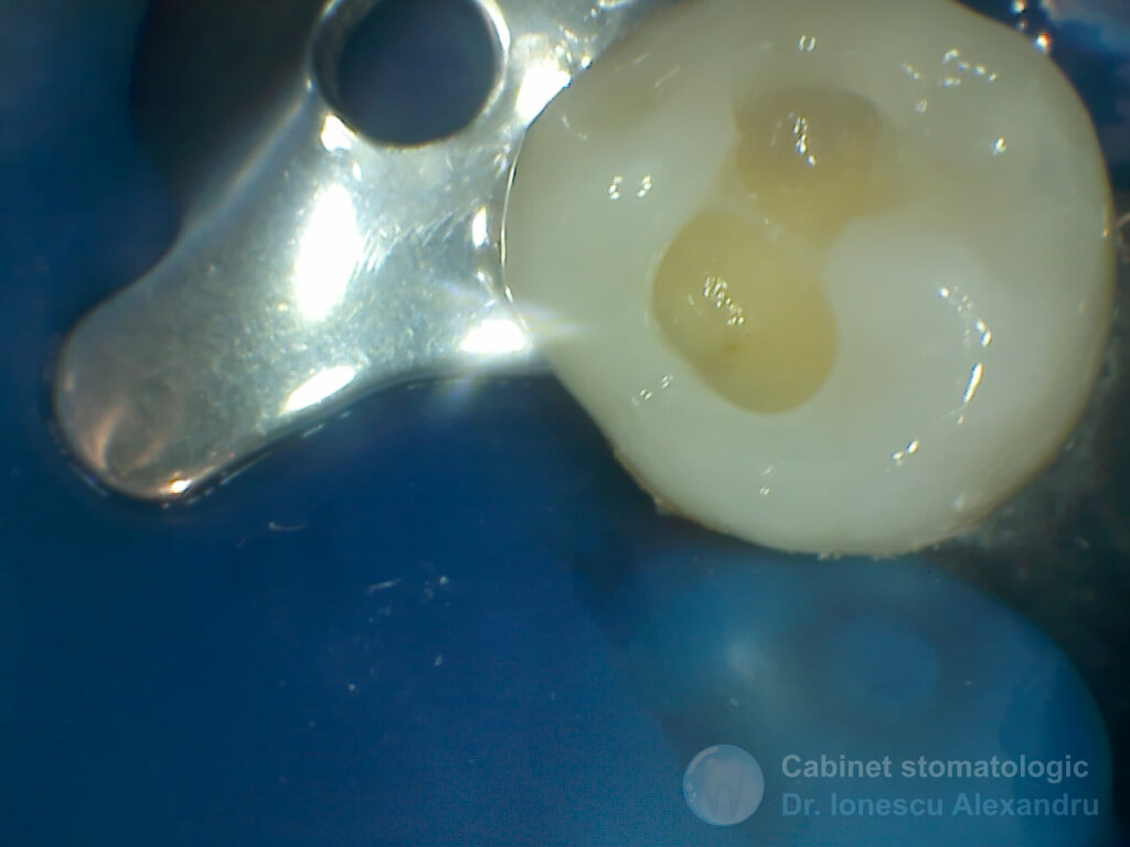 Obturaţie Compozit cu Casetă Distală la un Premolar Inferior - Reconstructie perete distal