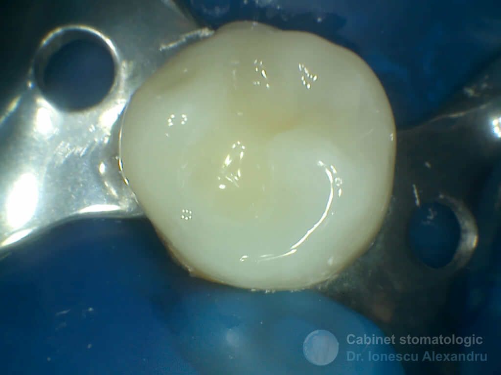 Obturaţie Compozit cu Casetă Distală la un Premolar Inferior - Imagine 4