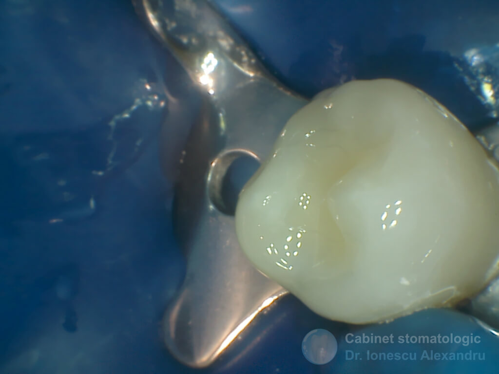 Obturaţie Compozit cu Casetă Distală la un Premolar Inferior - Imagine 5
