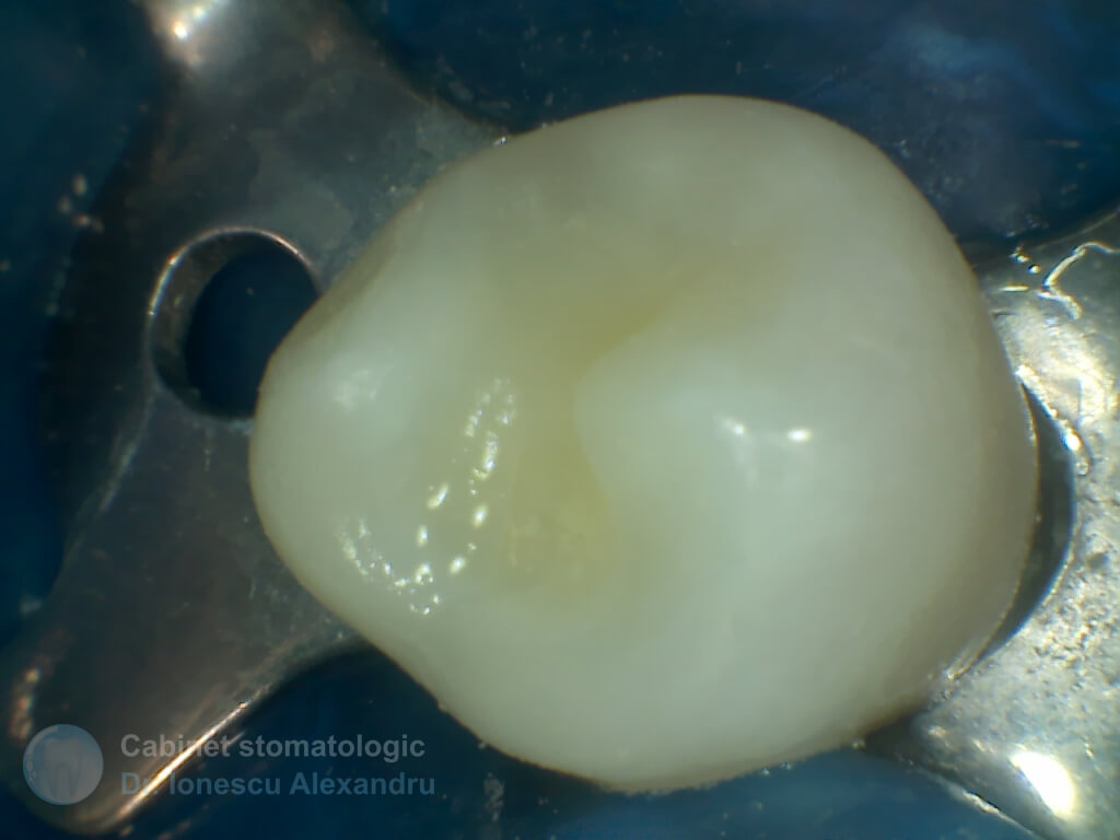 Obturaţie Compozit cu Casetă Distală la un Premolar Inferior