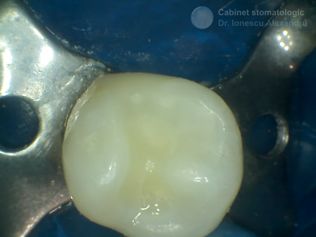 Obturaţie Compozit cu Casetă Distală la un Premolar Inferior - Finisare finală 3